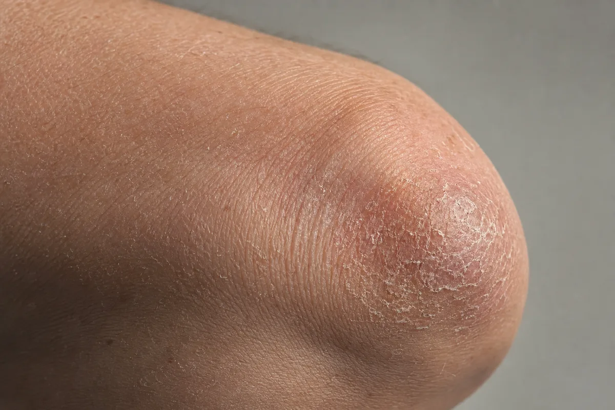 Peau du coude présentant des plaques squameuses de psoriasis en lumière naturelle