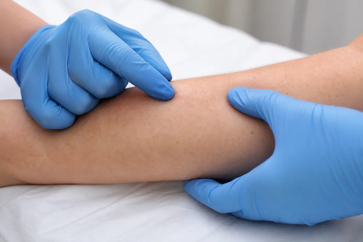 Consultation dermatologique, mains gantées examinant la peau d&rsquo;un avant-bras